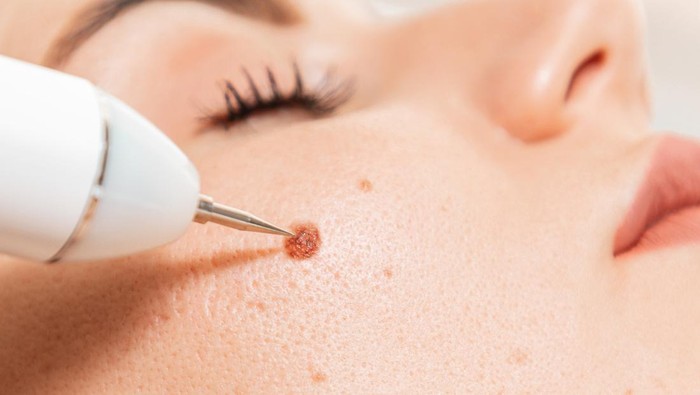 Microsurgery. Removal of birthmark from client's cheek with laser device. Close up. Concept of laser cosmelotogy and electrocoagulation.