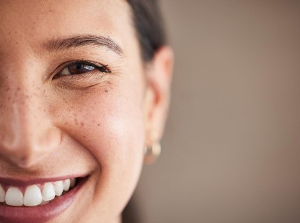 7 Fakta Menarik tentang Freckles, Ternyata Bisa Faktor Keturunan