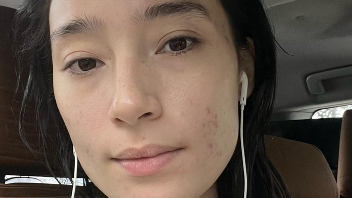 Selalu Cantik di Depan Publik, Ini Cerita Perjuangan Tatjana Saphira Sembuhkan Jerawat Selama 10 Tahun!