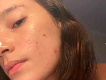 Tatjana Saphira Belajar Self Love dari Perjuangan 10 Tahun Sembuhkan Jerawat