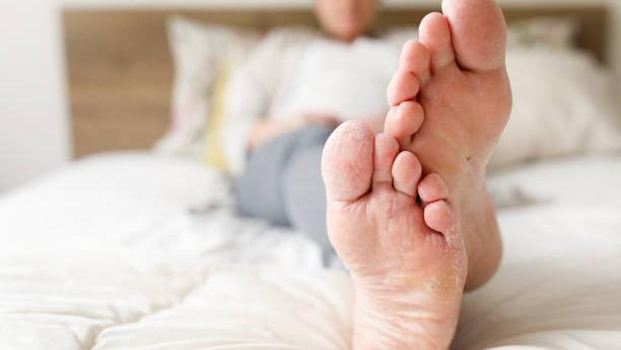 Ilustrasi kutu air di kaki Athlete's Foot
