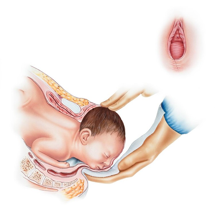 Ilustrasi melahirkan normal dan perineum Ilustrasi melahirkan normal dan perineum