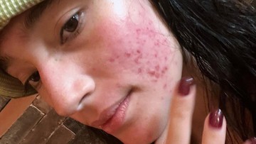 HIKMAH TATJANA SAPHIRA 10 TAHUN BERJUANG SEMBUHKAN JERAWAT: BELAJAR SELF LOVE