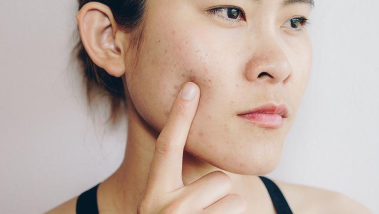 1063965962 Problems with acne and scar on the female skin.