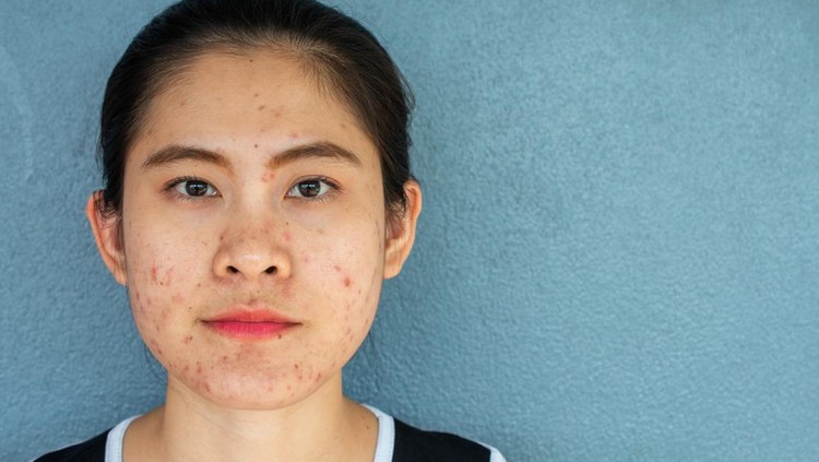 Inflamed acne consists of swelling, redness, and pores that are deeply clogged with bacteria, oil, and dead skin cells.