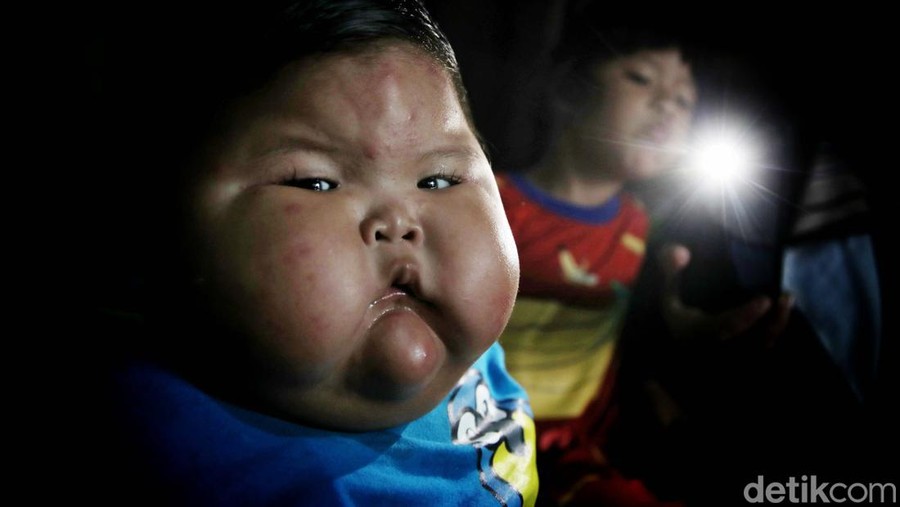 Kenzie Si Bayi Viral Obesitas, 1 Tahun Beratnya 27 Kg Viral bayi bernama Kenzie, punya bobot 27 kilogram di usia satu tahun. Ibunda Kenzie, Pitriah mengungkapkan berat badan anaknya memang berlebih sejak ia lahir.
Akibat obesitas yang dialaminya, tumbuh kembang Kenzie terganggu. Tidak seperti bayi seusianya, Kenzie belum bisa berdiri tegak.