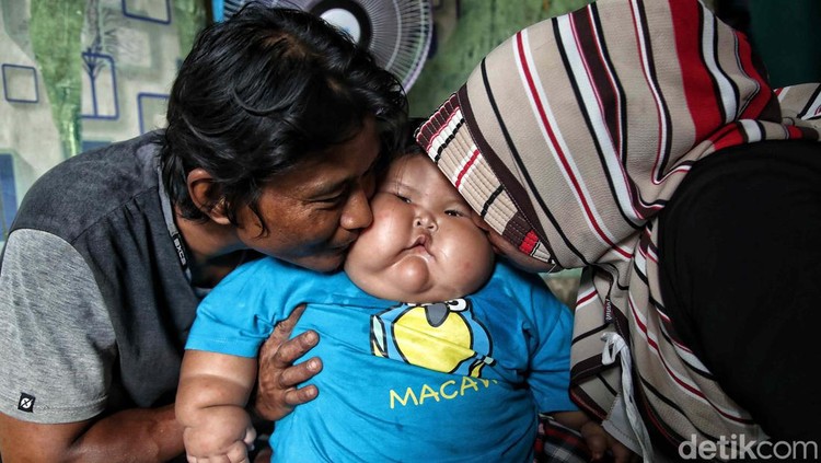 Kenzie Si Bayi Viral Obesitas, 1 Tahun Beratnya 27 Kg Viral bayi bernama Kenzie, punya bobot 27 kilogram di usia satu tahun. Ibunda Kenzie, Pitriah mengungkapkan berat badan anaknya memang berlebih sejak ia lahir.
Akibat obesitas yang dialaminya, tumbuh kembang Kenzie terganggu. Tidak seperti bayi seusianya, Kenzie belum bisa berdiri tegak.