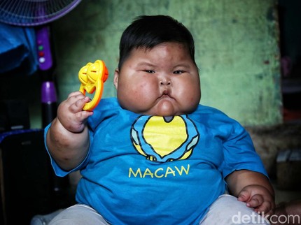 7 Potret Kenzie Asal Bekasi, Bayi Obesitas Berbobot 27 Kg di Usia 16 Bulan