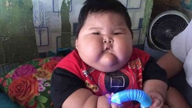 Balita Obesitas 27 Kg di Bekasi Jalani Rawat Jalan Sejak 2022