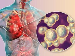 Kenali Gejala Pneumonia hingga Bisa Sebabkan Kematian