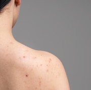 5 Penyebab Jerawat Punggung dan Cara Mudah Mengatasinya