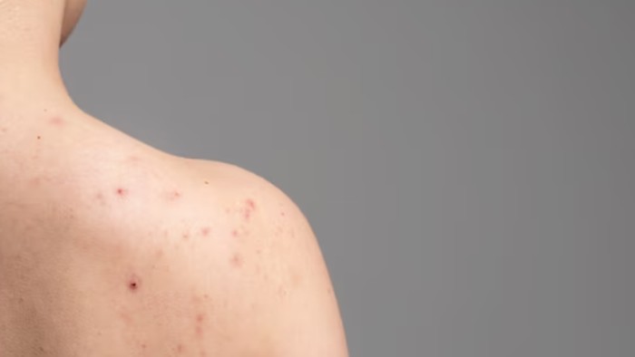 5 Penyebab Jerawat Punggung dan Cara Mudah Mengatasinya