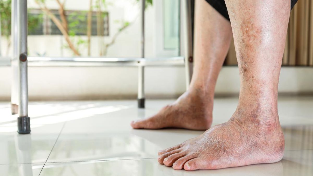 Letak Gatal Diabetes, Ini Bagian Tubuh yang Paling Umum Terasa