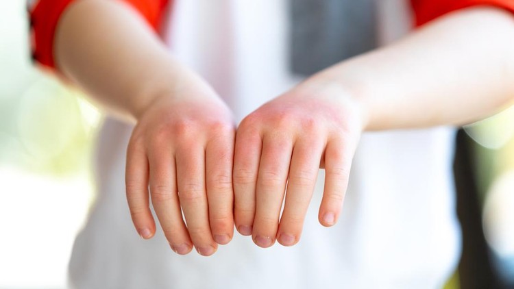Ilustrasi Anak Eczema A little redhead boy is showing the sunburn he has on his hands. His hands are very red and dry.