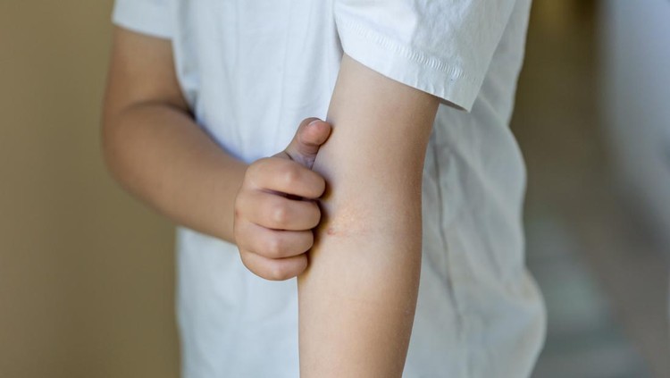 Ilustrasi Anak Eczema A little redhead boy is showing the sunburn he has on his hands. His hands are very red and dry.