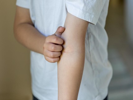 Mengenal Wet Wrap Therapy, Metode Pengobatan untuk Eksem Berat pada Anak