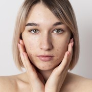 Beauties Sudah Tahu? Berikut 7 Cara Ampuh Mengatasi Wajah Breakout, Tanpa Harus Repot!