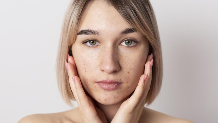 img-title Beauties Sudah Tahu? Berikut 7 Cara Ampuh Mengatasi Wajah Breakout, Tanpa Harus Repot!