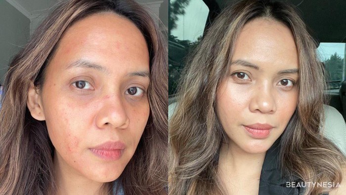 Beaupicks: Mencegah Penuaan Dengan Mencoba Perawatan Salmon DNA yang Populer