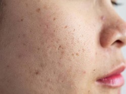 Gaduh Pakai Masker Bisa Bikin Bopeng, Memang Apa Kaitannya? Dokter Bilang Gini