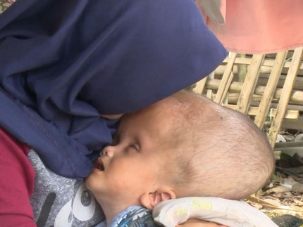 Kisah Sedih Anak Pekerja Serabutan Alami Hidrosefalus dengan Tubuh Tak Berdaya