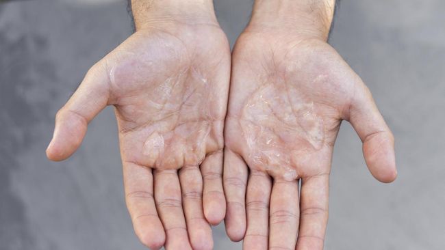 Meski umumnya tidak berbahaya, tangan berkeringat berlebihan dapat menurunkan kepercayaan diri dan kualitas hidup penderitanya.