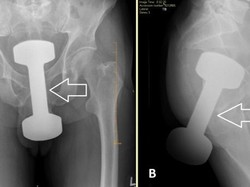 Viral Penampakan X-Ray Dumbell Masuk Dubur, Betulan di Indonesia?