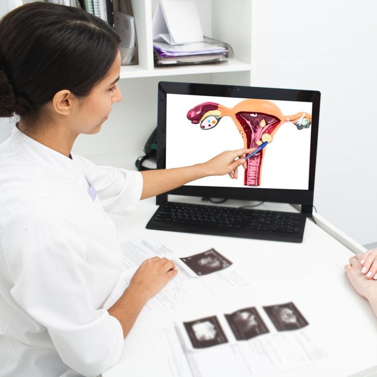 Ilustrasi fibroid dan rahim Ilustrasi fibroid dan rahim