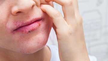 GEJALA HINGGA RISIKO PYTRIASIS ALBA