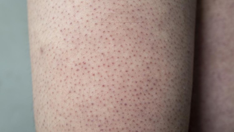Keratosis pilaris