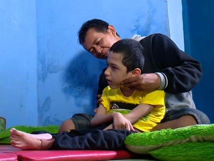 Nasib Pilu Anak Kembar Buruh Pemintal Benang: Alami Hidrosefalus hingga Epilepsi