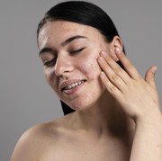 5 Hal yang Perlu Kamu Ketahui untuk Mengatasi Kulit Berminyak