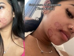 Viral Wajah Wanita Kena Ringworm gegara Berbagi Alat Make-up dengan Teman
