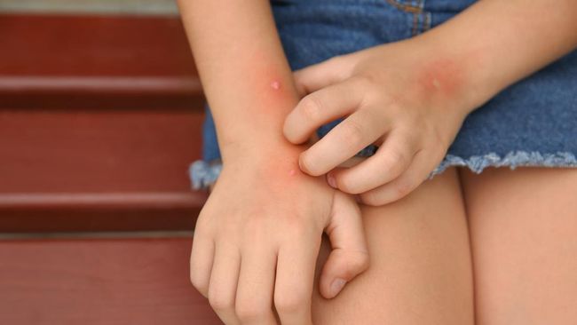 “Allergic Itching in Children: Symptoms, Triggers, and Treatment Options for Mothers”