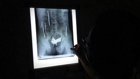 Cerita Dosen UIN Yogya: Istri Kena Sihir, Muntah Paku hingga Keguguran