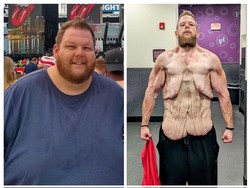 Viral Pria Berhasil Pangkas BB 120 Kg, Tapi Begini Efek Sampingnya