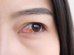 Penglihatan Wanita Ini Hilang Sebelah, Ternyata Gejala Kanker Paru-paru Ganas