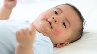 Alergi Panas pada Bayi: Kenali Penyebab, Gejala, dan Cara Mengatasinya