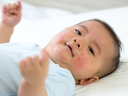 Alergi Panas pada Bayi: Kenali Penyebab, Gejala, dan Cara Mengatasinya