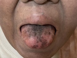 Ngeri! Lidah Wanita Ini Jadi Hitam dan Berbulu usai Minum Antibiotik
