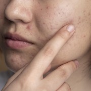 5 Cara Ampuh Hilangkan Bekas Jerawat yang Bisa Bikin Kulit Mulus Kembali