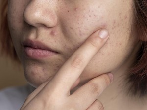 5 Cara Ampuh Hilangkan Bekas Jerawat yang Bisa Bikin Kulit Mulus Kembali