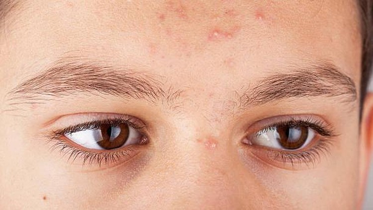 Forehead of a teenage boy with pimples