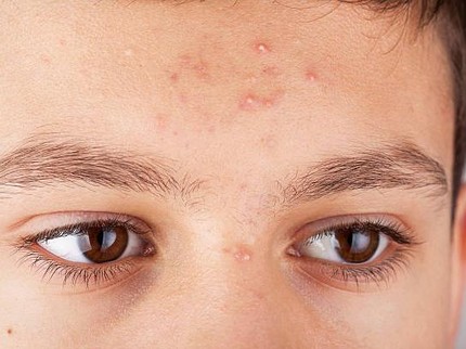 12 Kebiasaan Penyebab Kulit Beruntusan dan Jerawat Makin Memburuk
