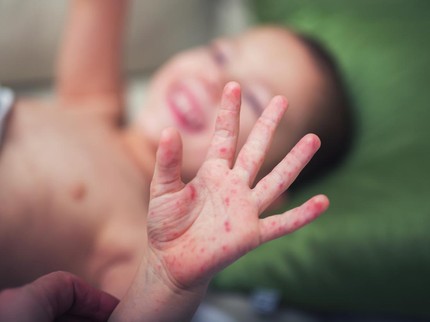 Pentingnya Vitamin A untuk Anak yang Terkena Campak, Catat Bun!