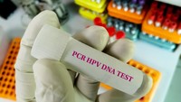 Skrining Kanker Serviks dengan HPV DNA Gratis di Jakarta, Bunda di Atas 30 Tahun Perlu Tahu