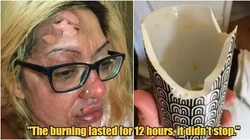 Viral Wajah Wanita Terbakar usai Coba Resep Telur Viral TikTok