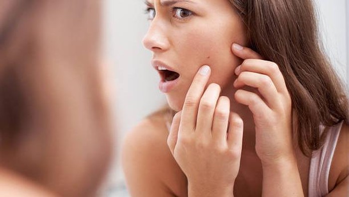 5 Tips Menghilangkan Jerawat Secara Alami dan Mencegahnya Muncul Kembali