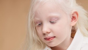 Anak Terlahir Albino, Apa Penyebabnya? Ciri, Risiko Komplikasi, dan Perawatan