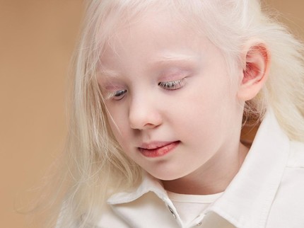 Anak Terlahir Albino, Apa Penyebabnya? Ciri, Risiko Komplikasi, dan Perawatan